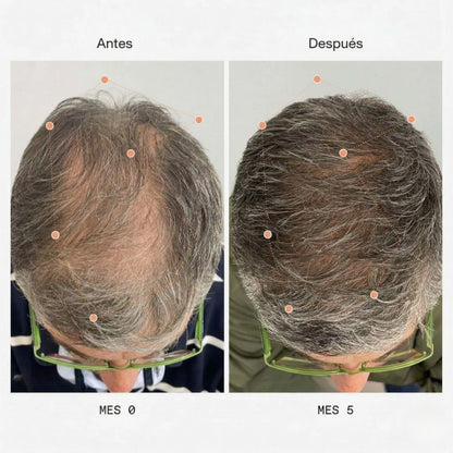 Kit x3 Frascos | Aceite Batana ORIGINAL + ROMERO | Estimula el Crecimiento del Cabello en 30 Días