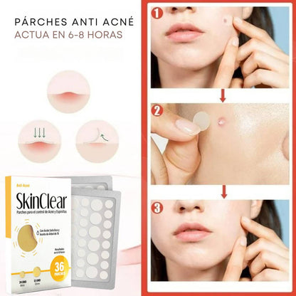 Parches Anti acné - ¡El secreto para decirle adiós a los granos mientras duermes!