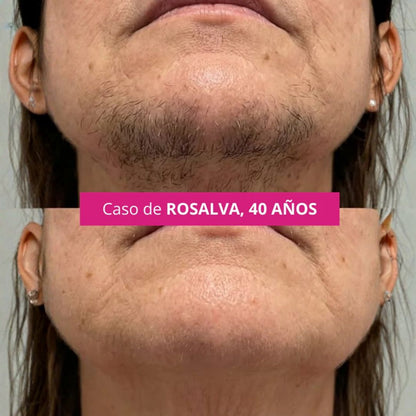 Cyperus Rotundus (30ml) | El aceite ideal para disminuir el crecimiento del vello corporal femenino