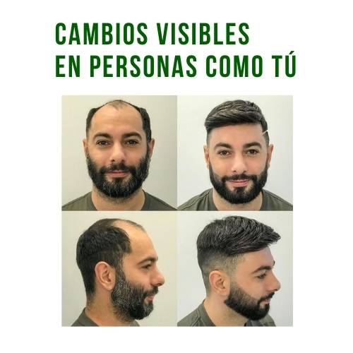 Kit 2X1 | Serum Capilar Mielle + Romero y Biotina | Recupera Tu Cabello Perdido Sin Químicos