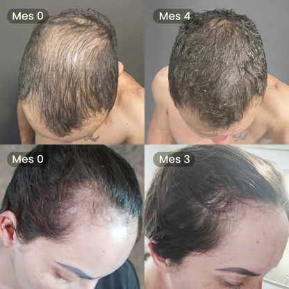 Kit 3x1 | Shampoo Batana ORIGINAL (300ml) + ROMERO | Recupera tu Cabello Perdido en Tan Solo 8 Semanas