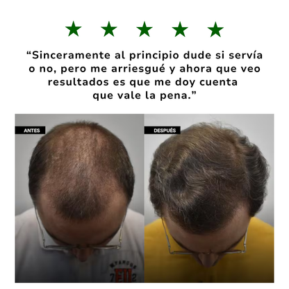 Kit 3x1 | Shampoo Batana ORIGINAL (300ml) + ROMERO | Recupera tu Cabello Perdido en Tan Solo 8 Semanas